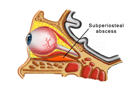 Image of an orbital abscess with a detailed illustration showing the affected area and corresponding text annotations.